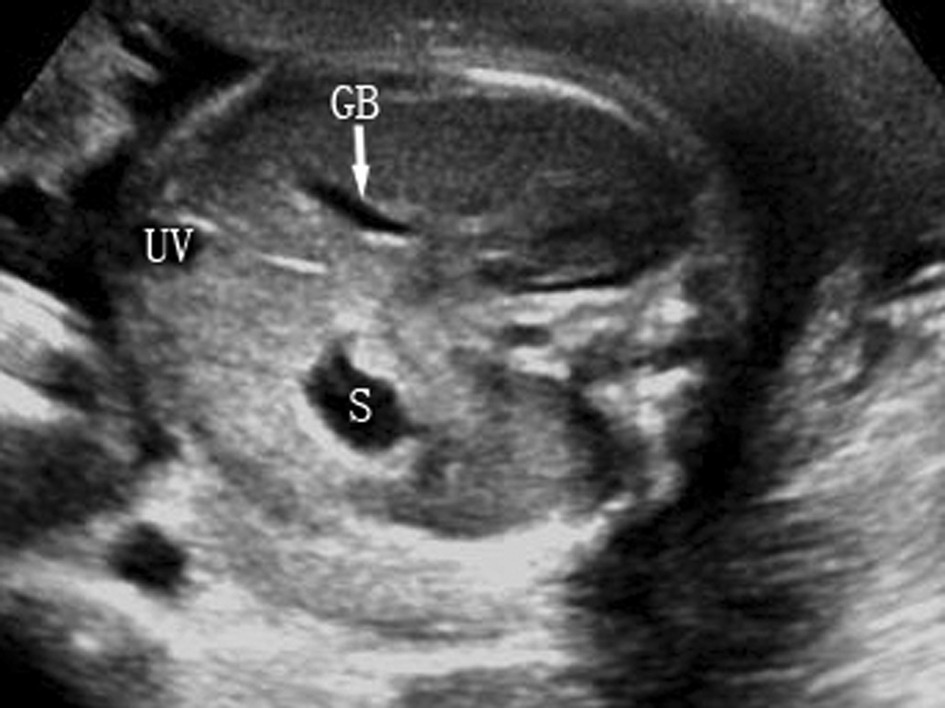 孕期不能忽视的胎儿超声检查,胎儿超声检查报告表