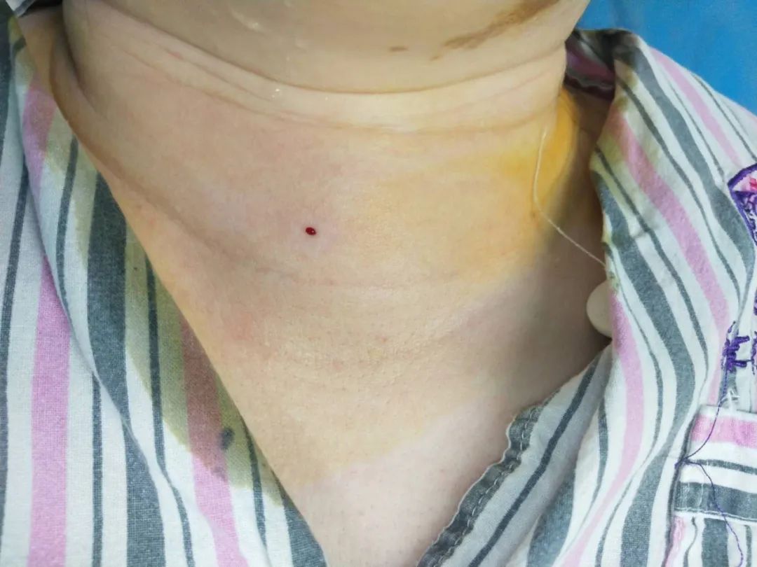 甲状腺结节心慌发热失眠,甲状腺手术成功案例