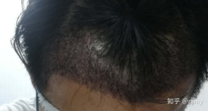 植发日记是什么,植发日记vlog第六天