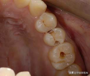 蛀牙什么情况需要根管治疗,蛀牙喝冷水痛要根管治疗吗