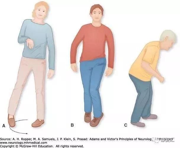 卒中康复后需要注意什么,卒中后痉挛表现和产生原因