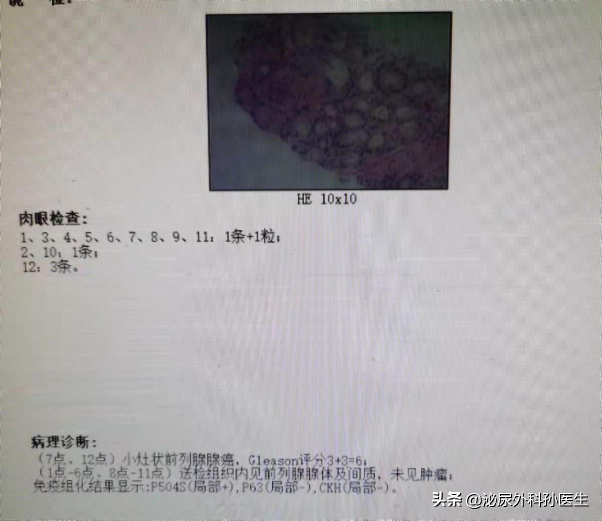 前列腺不典型小腺泡增生是癌症吗,前列腺增生血尿会是癌症吗