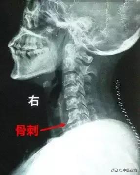 北京中医医院马彦旭主任：你的颈椎变直了么？别怕，中医有办法！