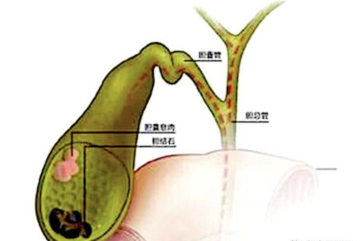 胆囊息肉癌前病变能活多久,胆囊息肉属于癌前病变吗