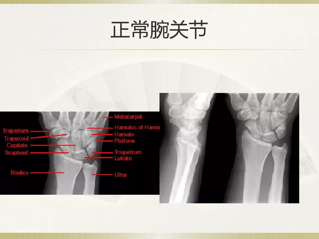 骨科x光片读片技巧,放射科骨科读片教程
