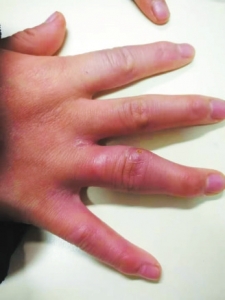 幼年特发性关节炎对孩子的影响,少儿特发性腿关节炎