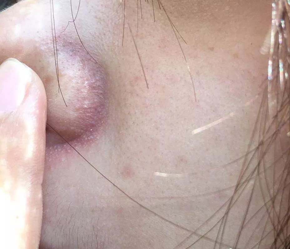 鼻翼两侧的沟发红是怎么回事,为什么鼻翼两侧泛红有小点