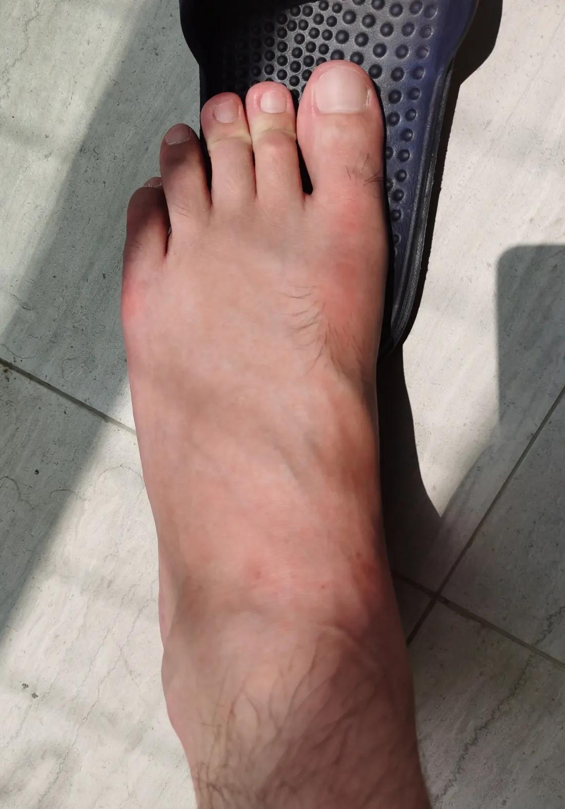 第五跖骨粉碎性骨折多久后能走路,第五跖骨基底骨折100天了走路肿