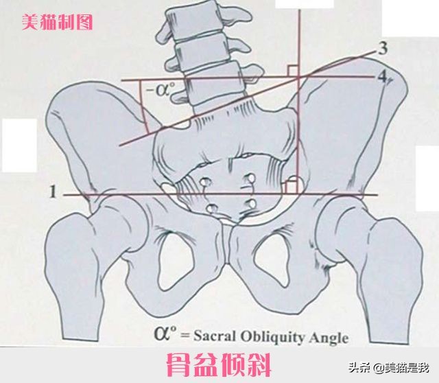 长短腿跟腿型能矫正吗,长短腿矫正锻炼方法左腿长右腿短