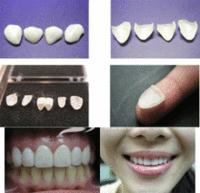 牙齿种植和口腔修复,口腔咨询牙齿矫正提问技巧