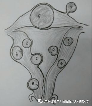 子宫肌瘤引起“大姨妈”排山倒海,淋沥不净……针眼妙方解除烦恼