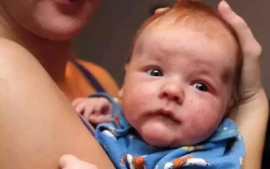 宝宝痤疮和湿疹的区别,宝宝竟然也会长青春痘