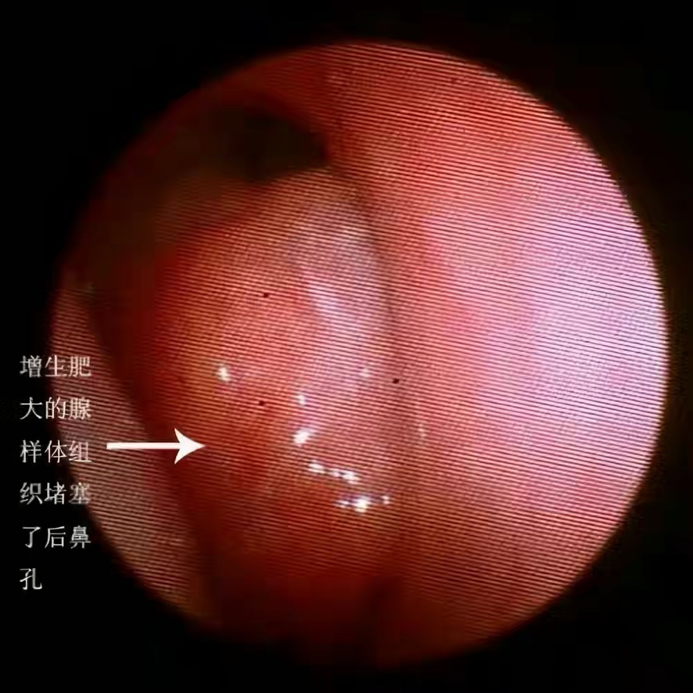 省中医看腺样体肥大哪个医生最好,儿童腺样体重度肥大的危害