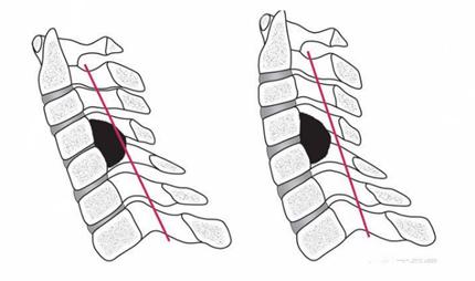 颈椎后纵韧带骨化症是颈椎病吗？该怎么办？