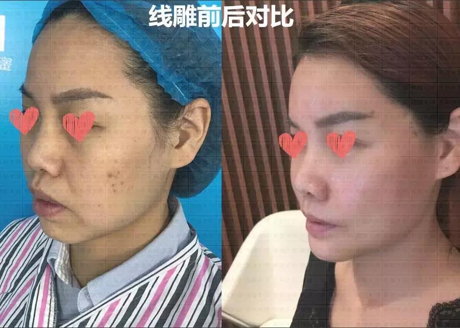 线雕贵还是玻尿酸贵,线雕的线贵不贵