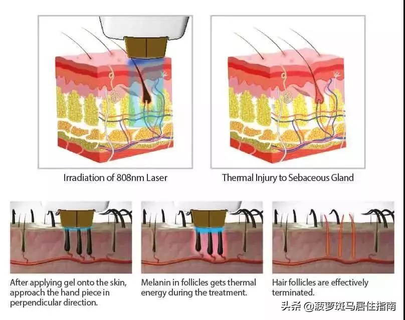 脱毛方法大盘点,脱毛攻略不要广告