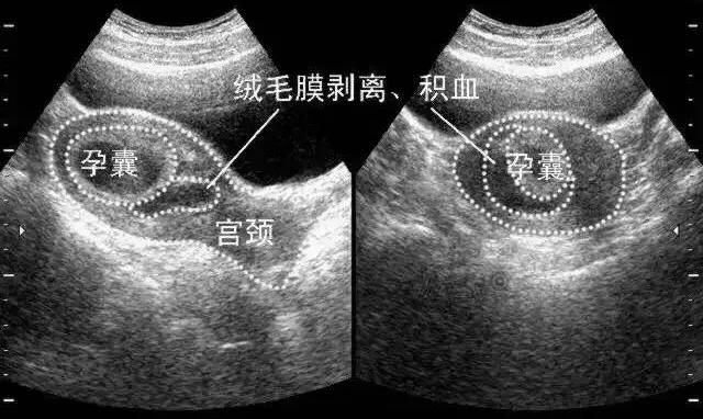 怎么劝流产,对于流产的认识