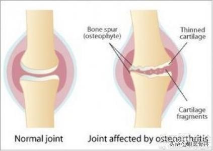 骨质增生引起的骨关节疼痛怎么治,30多岁退行性骨关节病怎么办