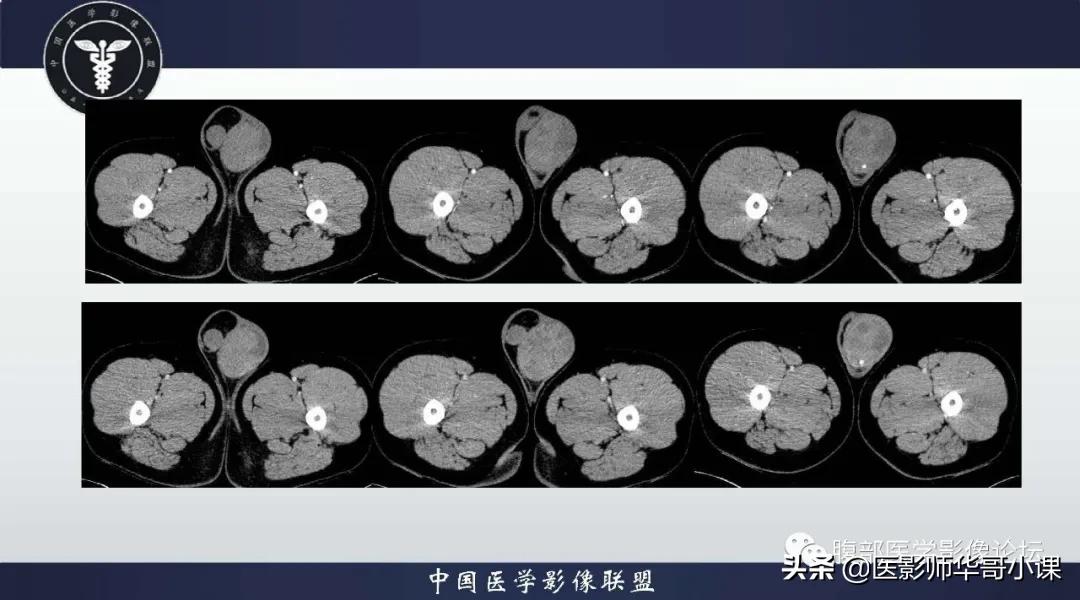 [精品课件]畸胎瘤及精原细胞瘤（*丸睾**肿瘤及肿瘤样变CT及MR表现）