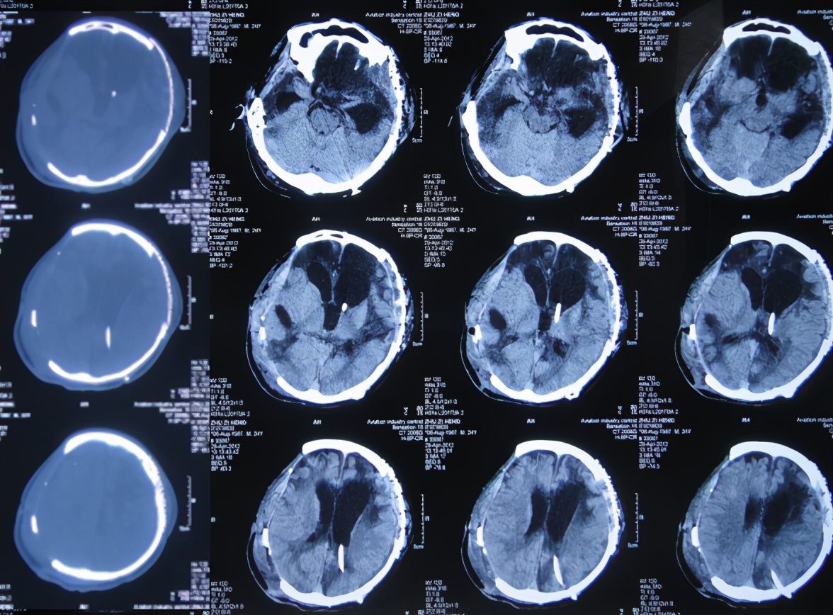 脑受伤开颅手术昏迷,开颅手术后20天发生脑积水引流