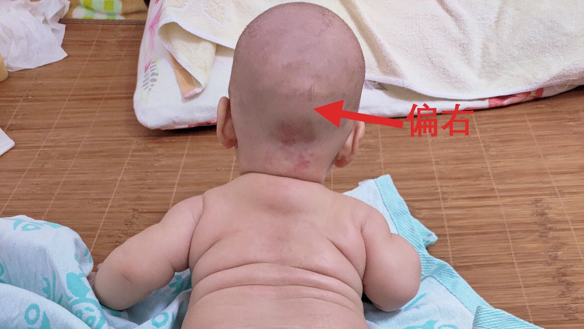 100天偏头还可以矫正吗,一岁宝宝有点偏头还能纠正