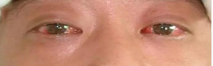 眼睛大是什么综合症,眼睛大是什么病征兆