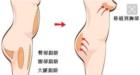 自体脂肪丰臀丰胸后多久可以锻炼,自体丰胸后多长时间可以按摩