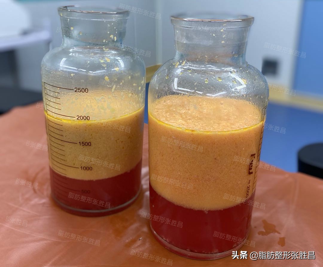 为什么吸脂会吸出血水是失败了吗,吸脂血水多有效果吗