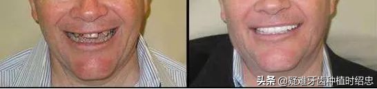 孩子牙只剩残根怎么换牙,只剩残根的牙真的能补救吗