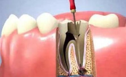 牙疼都是感染到牙髓吗,牙疼坏到牙髓了咋办