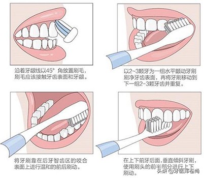 牙齿楔形磨损怎么补救,牙齿楔形缺损怎么处理