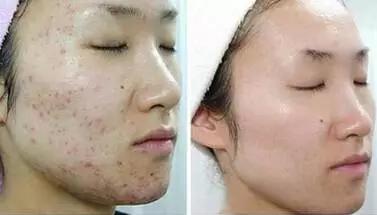 鍋氱編瀹瑰幓姣涘瓟绮夊埡榛戝ご鐥涘悧,鍋氱編瀹圭鐥樺潙