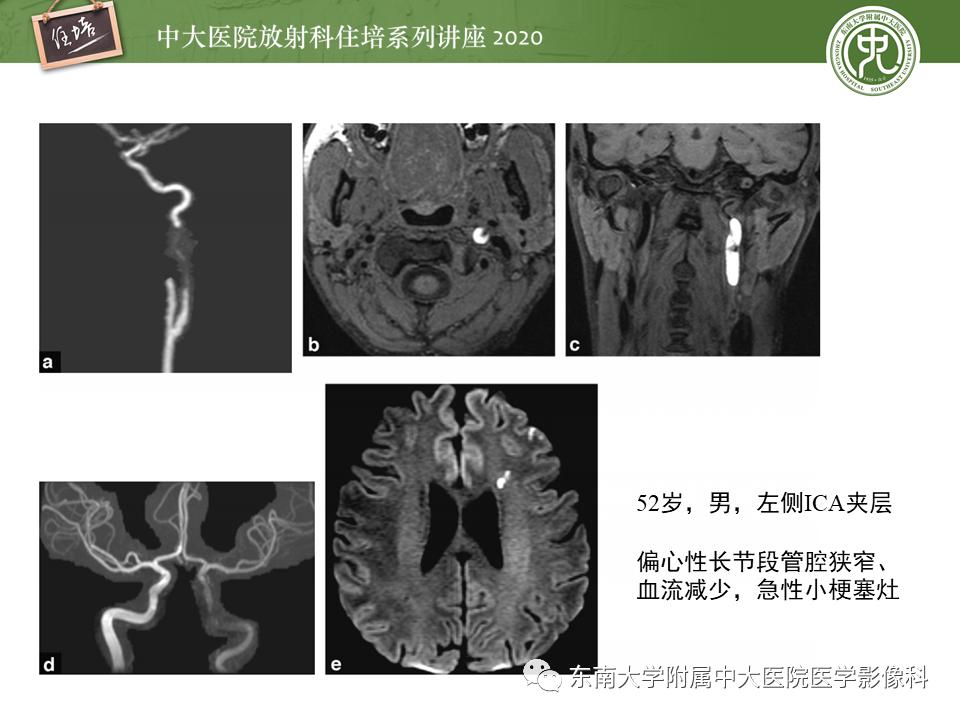 颈动脉夹层的超声表现及漏诊分析,动脉夹层与夹层动脉瘤是一样的吗