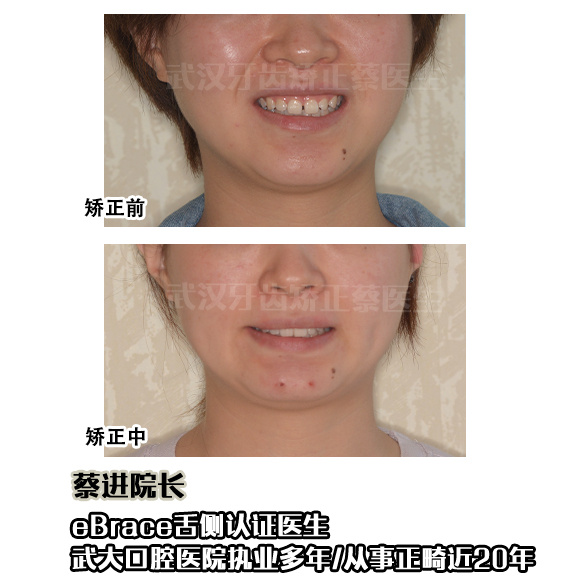 武汉矫正牙齿去哪里做最好,武汉成人牙齿矫正牙齿不齐