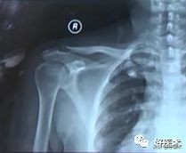 治疗肩锁关节脱位，有最好的方法吗？