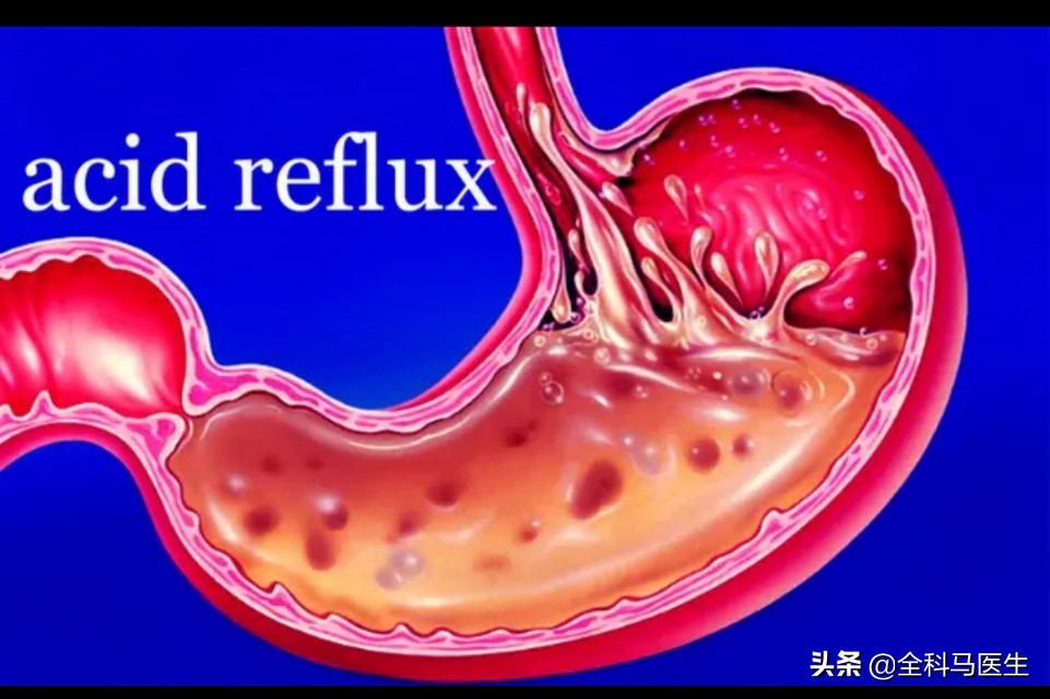 糜烂性胃炎患者吃什么食物养脾胃,浅表性胃炎伴糜烂吃什么食物养胃