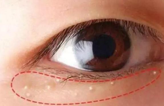 赵丽颖卧蚕眼袋,赵丽颖有眼袋与无眼袋