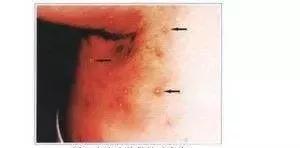 反复口腔溃疡怎么排除白塞病,反复口腔溃疡与白塞病