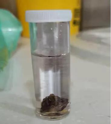 气管呛入异物最佳处理方法,呛住气管异物怎么自救