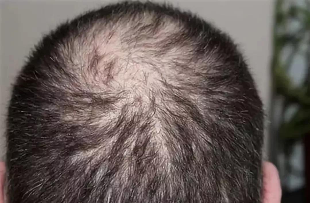 刘亦菲颅顶怎么那么高,刘亦菲高颅顶和低颅顶的区别图片