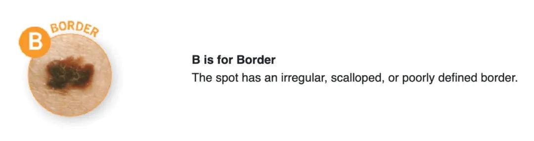 宝宝刚长出来的痣怎么消除,婴儿先天的痣容易癌变