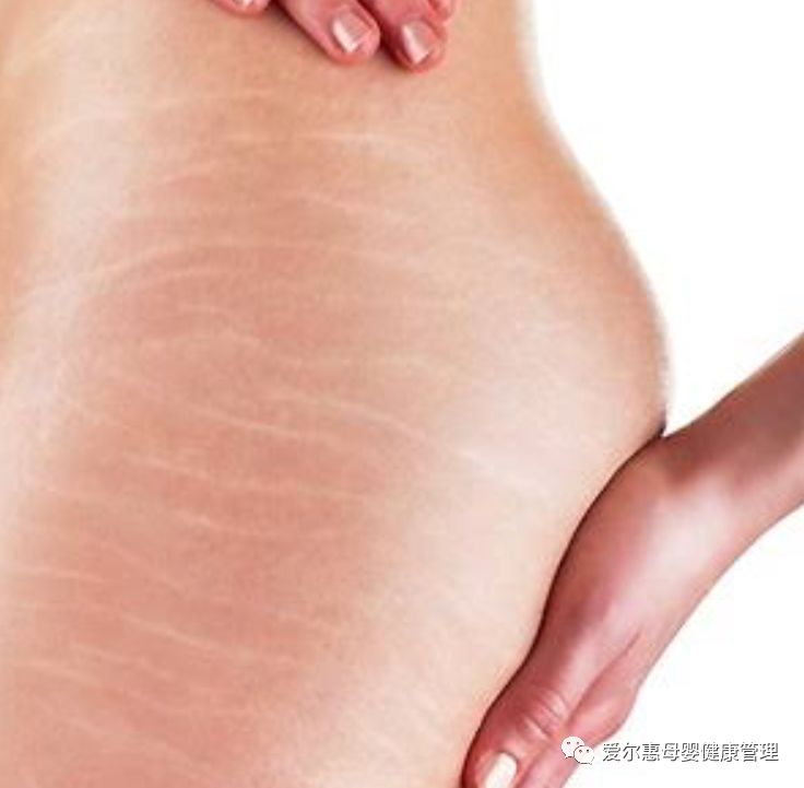 拒绝妊娠纹手法,拒绝怀孕措施