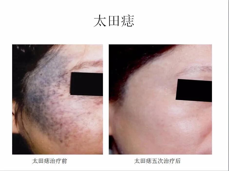 微微之光，让我记住你的美——陕西省皮防所医院超皮秒、热玛吉媒体专场活动圆满结束