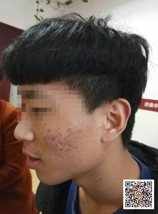 怎样治疗青春痘最有效的方法,怎样治青春痘最有效的方法