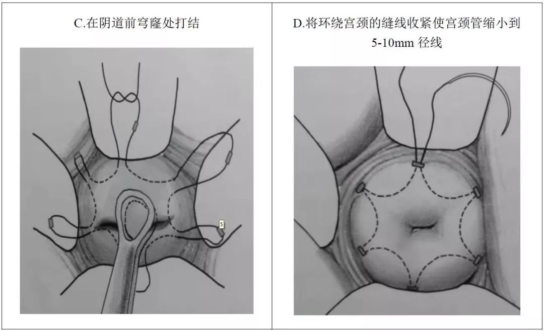 孕21周做宫颈环扎术成功率有多少,孕前腹腔镜宫颈环扎术过程及弊端