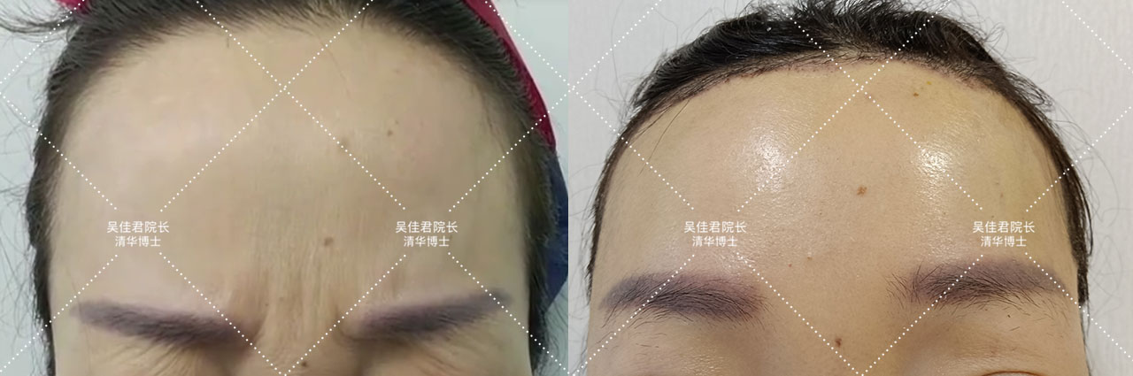 小切口拉皮除皱术适合额头除皱吗,额头缩小大拉皮手术恢复过程