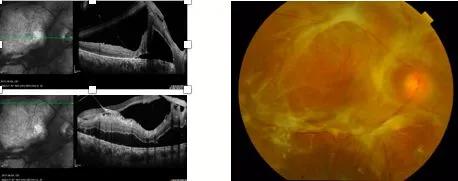 因糖尿病导致的失明怎么诊断,糖尿病眼瞎早期的症状是什么