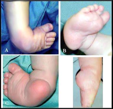 脑瘫儿童，早期如何医治可以大大改善患儿的生活质量？