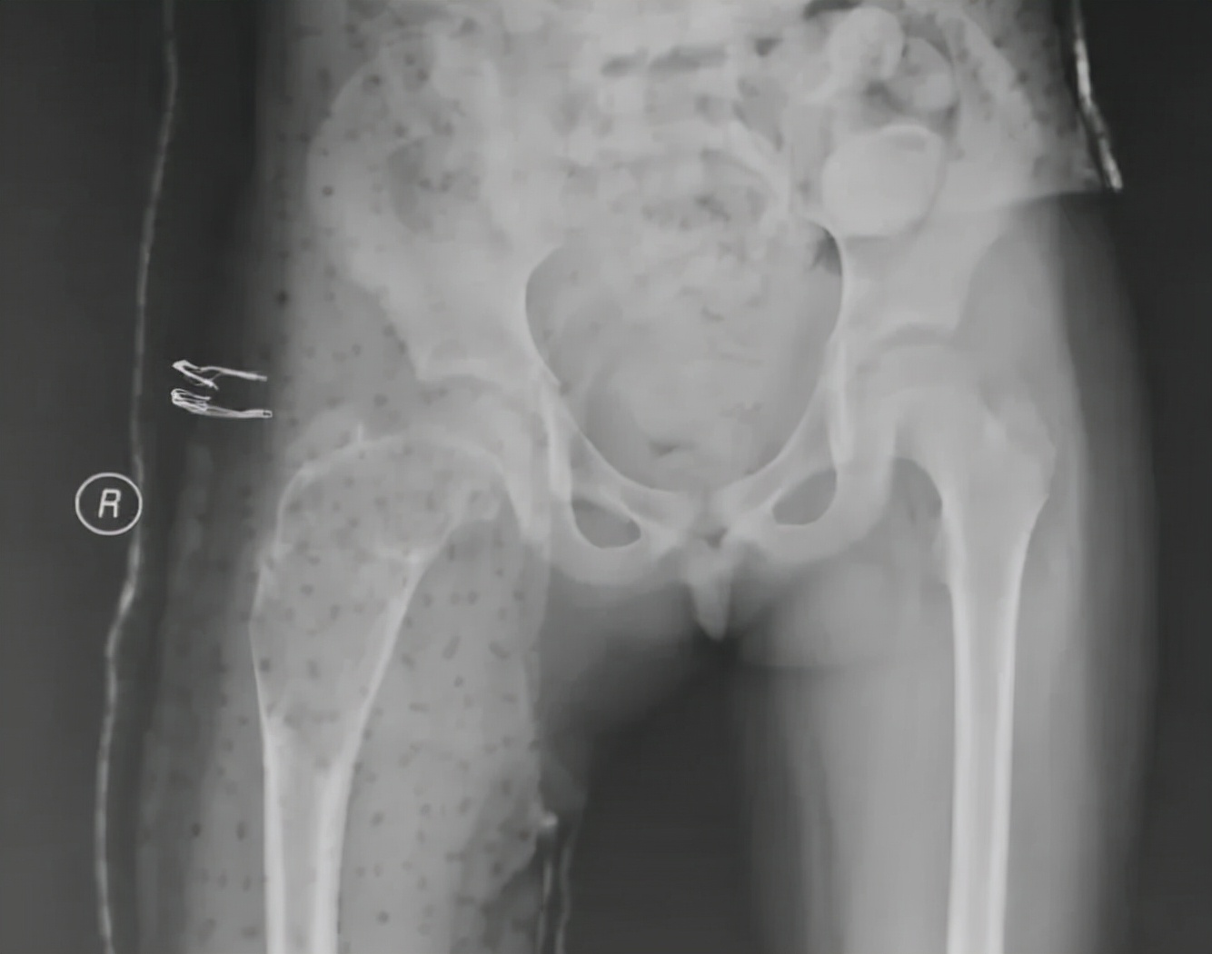 骨与软组织肿瘤治疗指南,骨与软组织肿瘤诊疗指南