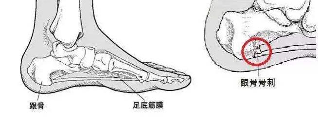 足背部疼痛常见原因是什么引起的,足跟痛的5种常见疾病解析